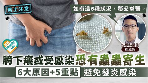 陰毛痕癢